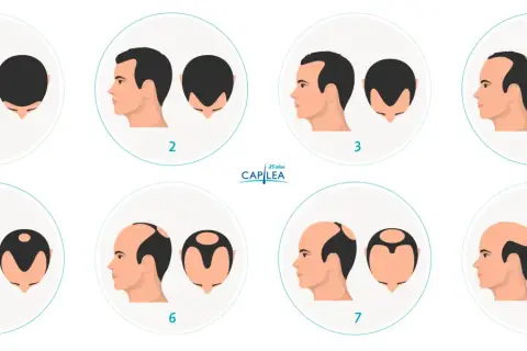 Escala de Norwood que muestra la progresión de la pérdida de cabello, desde una densidad capilar completa hasta la calvicie.