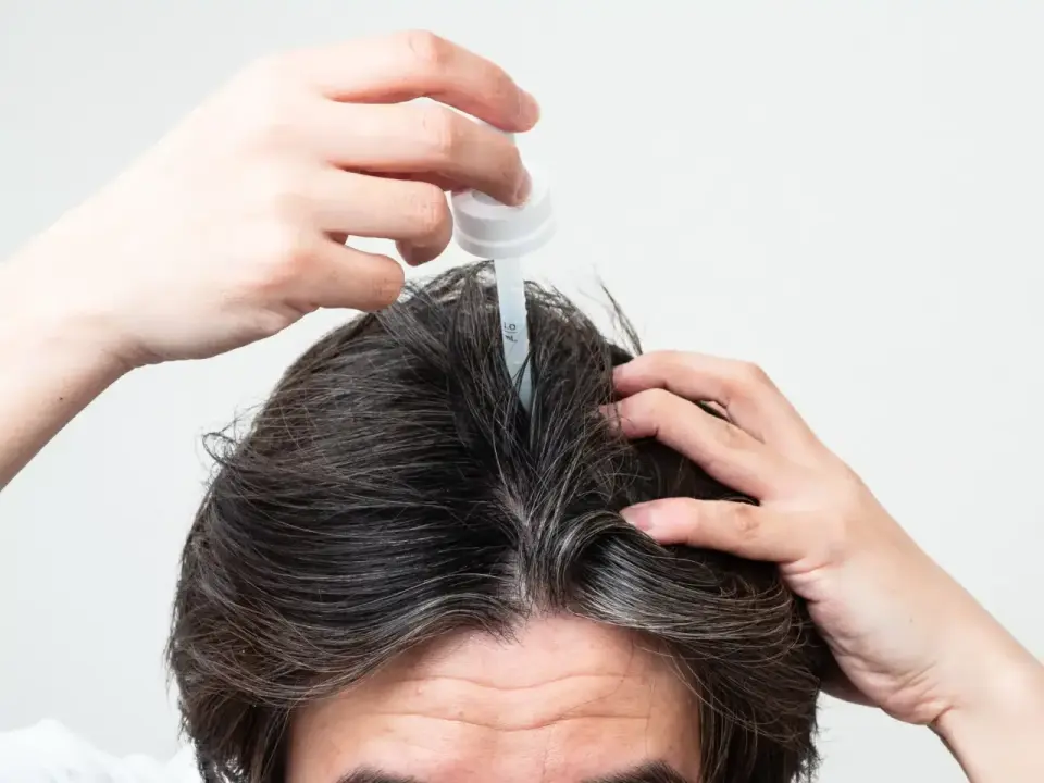 ¿Qué alternativas al minoxidil te convienen según tu caída capilar?